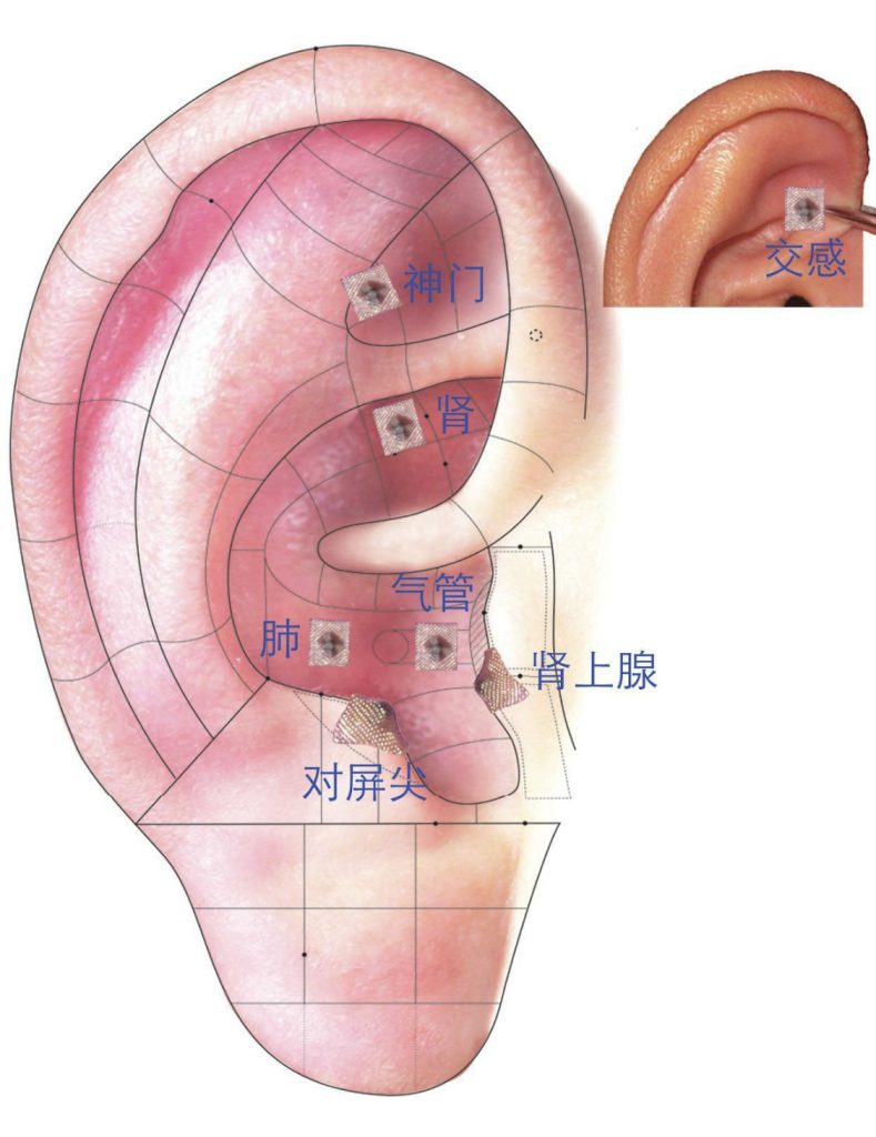 零起点耳穴使用教程——哮喘-学生保健论坛-中医保健-阿亮理疗